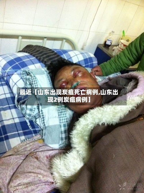 最近【山东出现炭疽死亡病例,山东出现2例炭疽病例】